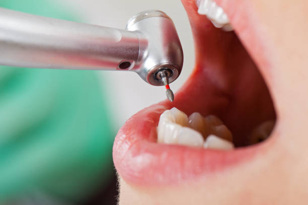 Best Emergency Dental Care for Broken or Chipped Teeth in Stratford, TX
